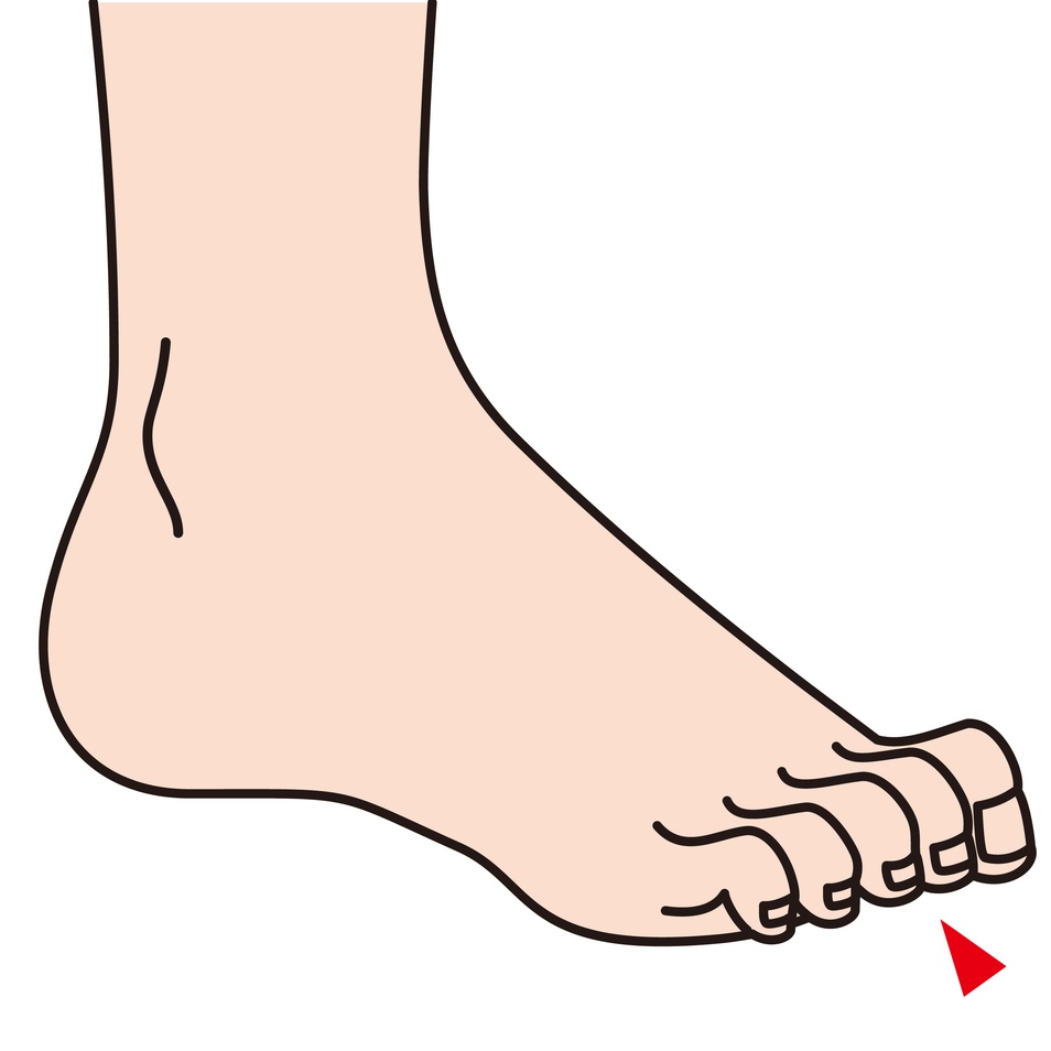 昔から外反母趾で足の指が軽く曲がってる感じで、左足の左から2番目の指が痛む原因と治療はどうしたら良い？