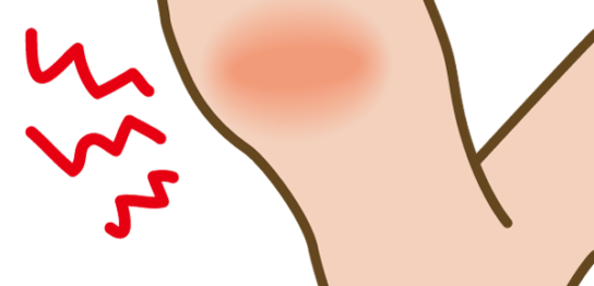 「モートン病」「中足骨骨頭痛」の原因と治し方。歩くと痛い。サポーターやテーピングでは治らない理由。マッサージも無駄なんです。