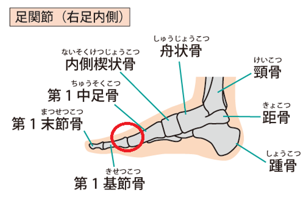 母趾中足趾関節（MTP関節）に変形性関節症が生じる疾患を強剛母趾