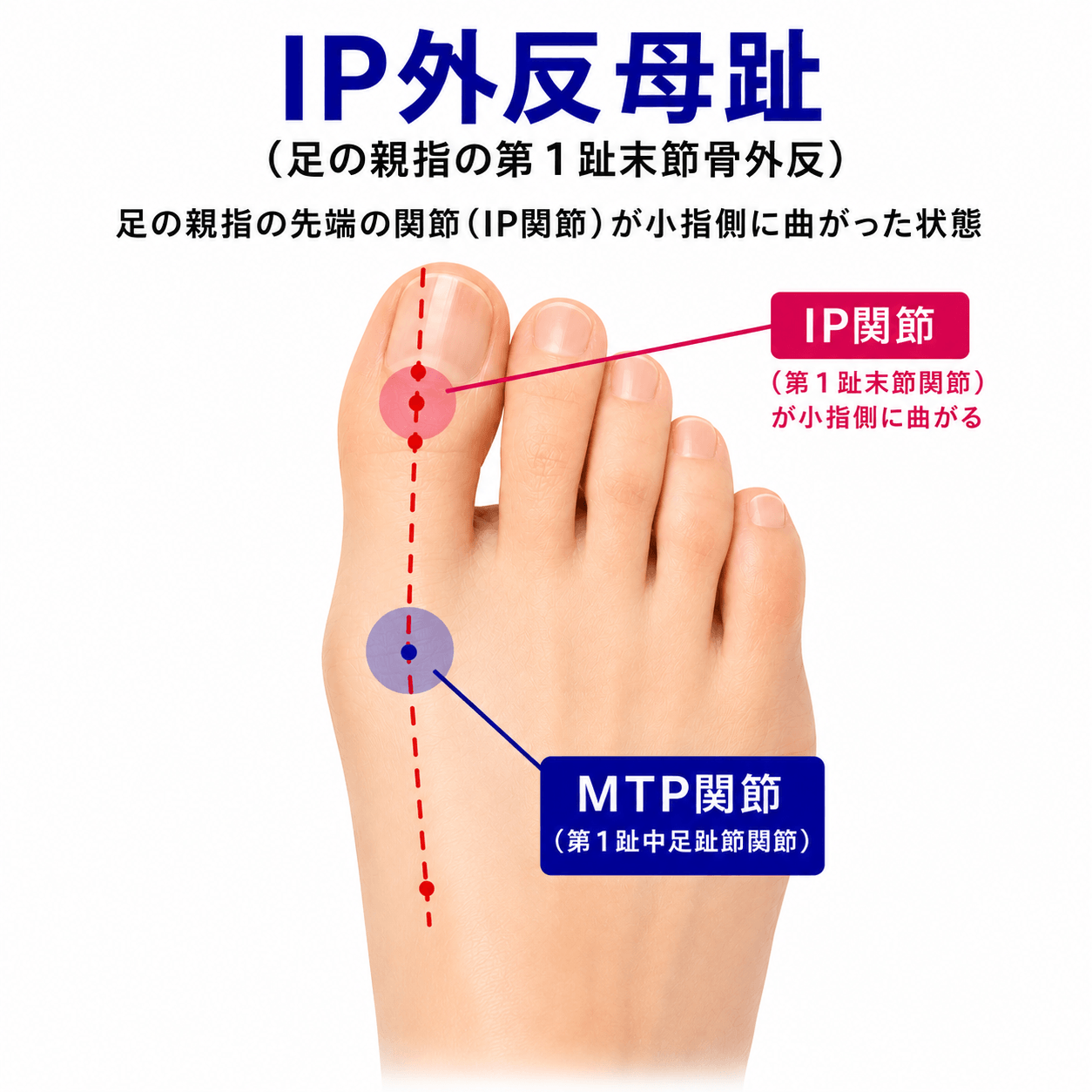IP外反母趾