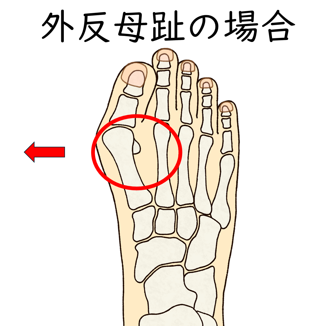 外反母趾は親指に繋がる中足骨が足の内側に広がっていく症状