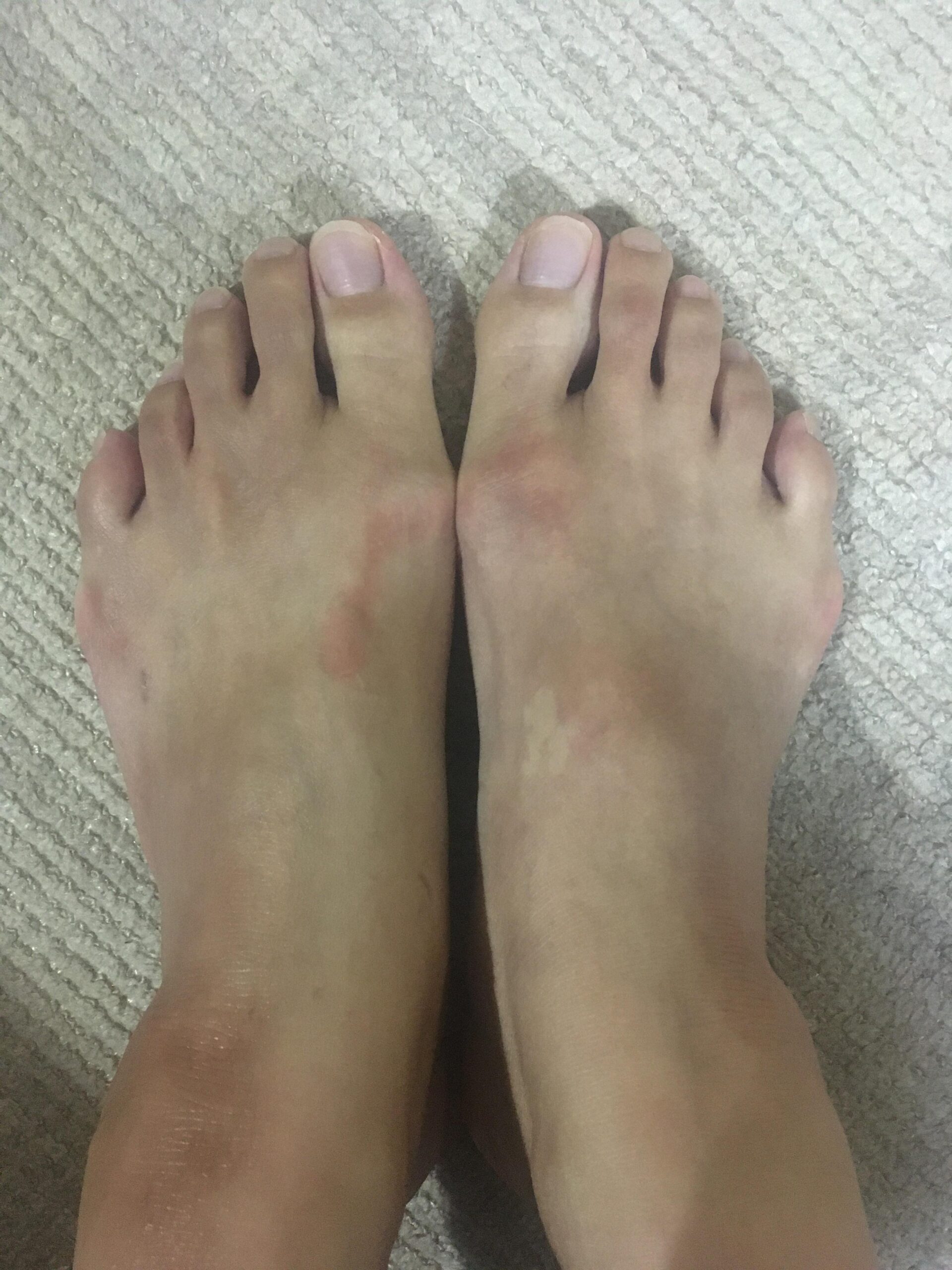 軽度の外反母趾なら、半年で自分で治ます。外反母趾の治し方を解説中。